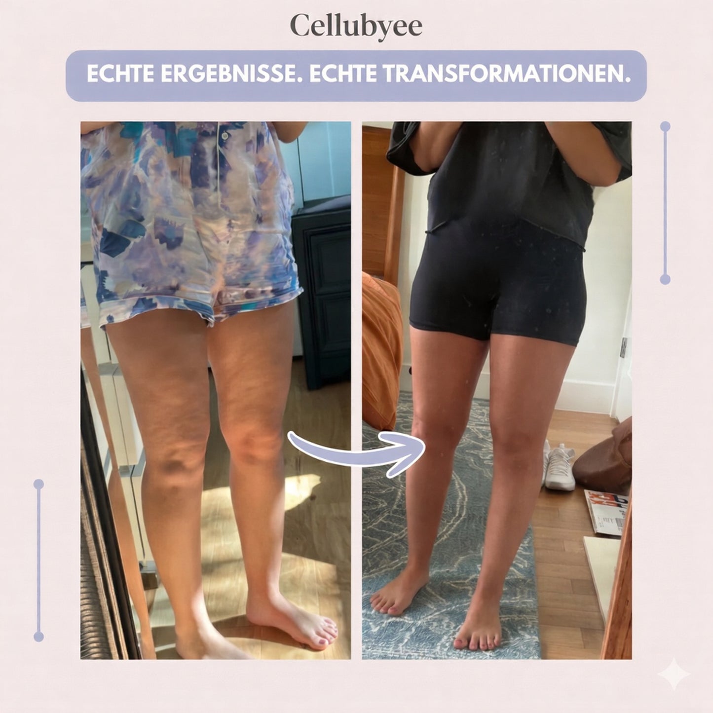 Cellubyee 3D Leggings – Sanfte Entlastung bei Lipödem: Schmerzen und Schwellungen natürlich reduzieren