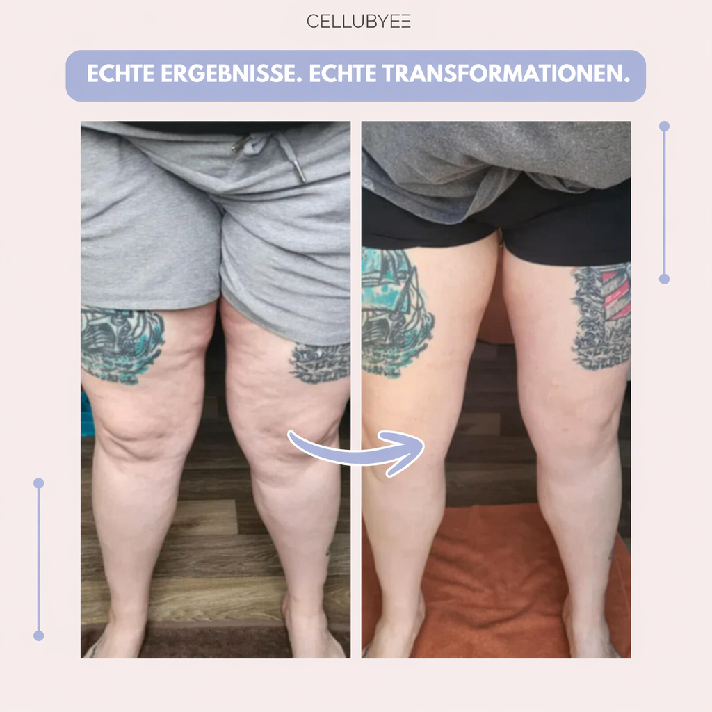 Cellubyee 3D Leggings – Sanfte Entlastung bei Lipödem: Schmerzen und Schwellungen natürlich reduzieren