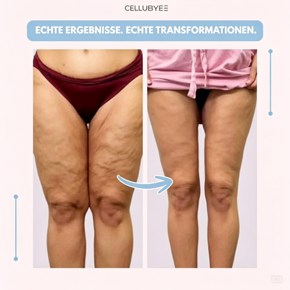 Cellubyee 3D Leggings – Sanfte Entlastung bei Lipödem: Schmerzen und Schwellungen natürlich reduzieren